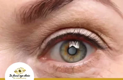 عملية-ازالة-المياه-البيضاء،-كيف-يتم-تخدير-عملية-المياه-البيضاء