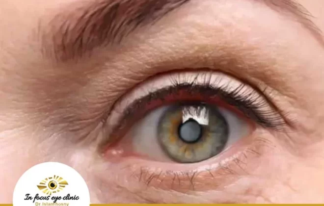 عملية-ازالة-المياه-البيضاء،-كيف-يتم-تخدير-عملية-المياه-البيضاء