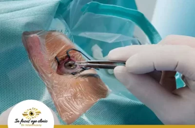 عملية-زرع-القرنية