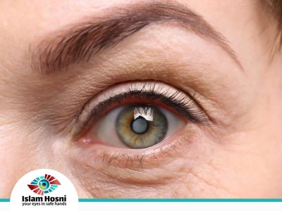 عملية ازالة المياه البيضاء