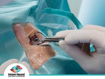 عملية زرع القرنية