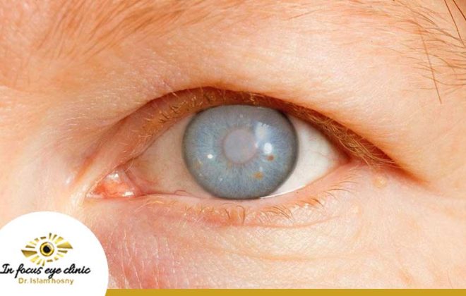 اعراض المياه البيضاء في العين