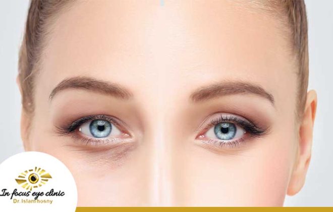 تجربتي مع عملية شد الجفون 4 تجربتي مع عملية شد الجفون