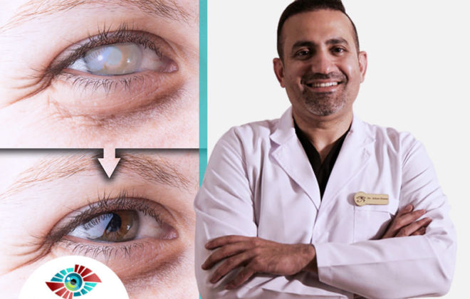 تكلفة عملية المياه البيضاء في العين مع د اسلام حسني