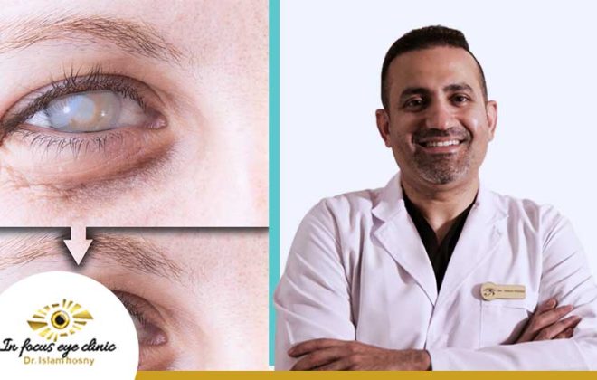 تكلفة-عملية-المياه-البيضاء-في-العين