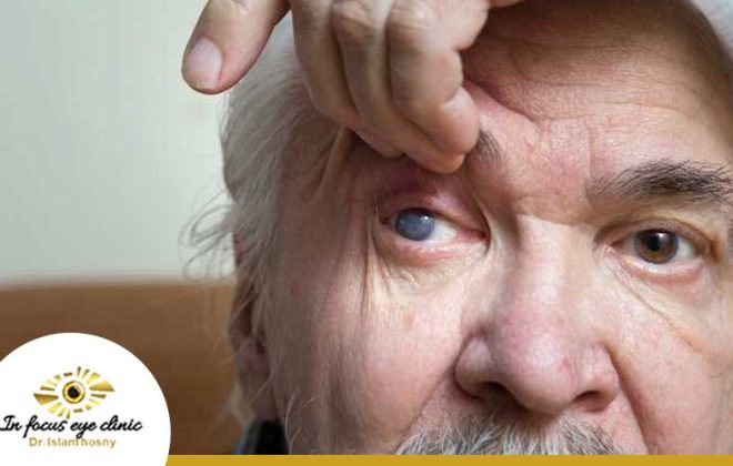 عملية المياه البيضاء لكبار السن 3 عملية-المياه-البيضاء-لكبار-السن-1