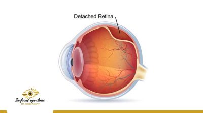 عملية انفصال الشبكية في العين