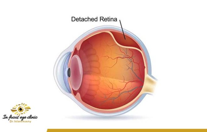 إزالة-زيت-السليكون-بعد-عملية-انفصال-الشبكية