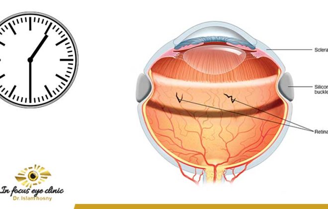 كم تستغرق عملية انفصال الشبكية