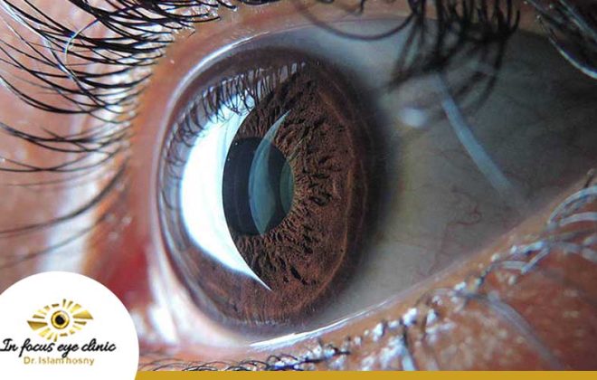 علاج انفصال الشبكية الجزئي