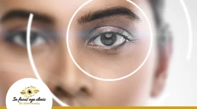 متى يستقر النظر بعد عملية المياه البيضاء