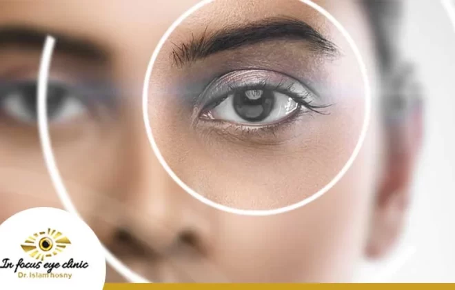 متى يستقر النظر بعد عملية المياه البيضاء