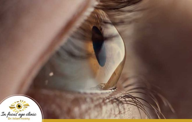 قرنية العين ومشاكلها