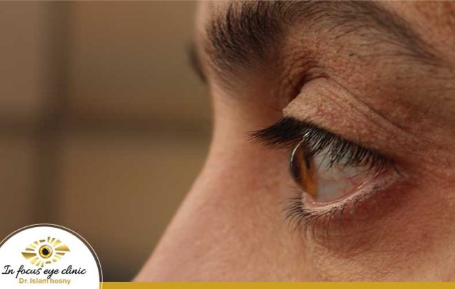 هل القرنية المخروطية تسبب العمى